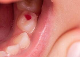 Installation of a colored red filling in a milk tooth for a child. Colored fillings in dentistry for children. Treatment of pulpitis and deep caries, close-up photo