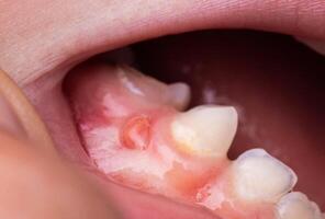 A bump is a tumor on the tooth gum in a child. Periodontitis in children due to a tooth with pulpitis. Close-up photo