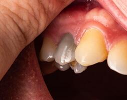 Black tooth in the mouth of a man after nerve depulpation. Dead darkened tooth, macro photo