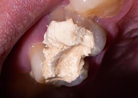 Installation of a temporary filling in the treatment of tooth canals, endodontics. Tooth pulpitis in dentistry, macro photo