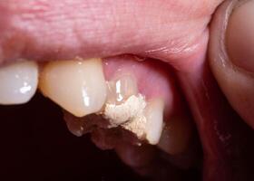 Tooth filling with temporary cement for root canal treatment. Tooth nerve removal, preparation for prosthetics, macro photo
