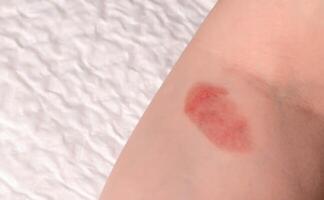 Red spot on the skin, skin damage from a burn on the arm. Copy space for text photo