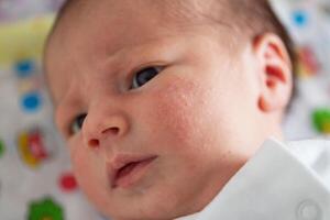 Pimples on the face of a newborn. Baby's adaptation to the environment, close-up photo
