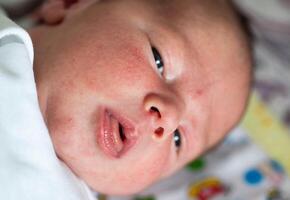 Rash on the face of a newborn baby. The process of formation of the hormonal system, close-up photo