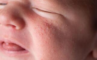 Allergic pimples in a newborn on the face. Pathogenesis, acne of newborns. photo