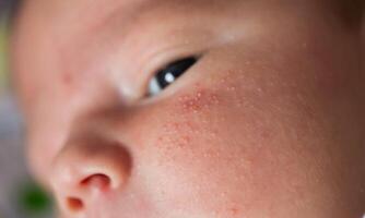 Rash on the face of a newborn baby. The process of formation of the hormonal system, close-up photo