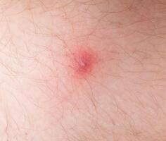 Red pimple on problem skin, close-up, background photo