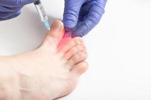 The doctor makes an injection between the toes against hyperhidrosis sweating. Unpleasant foot odor treatment concept. Copy space for text photo