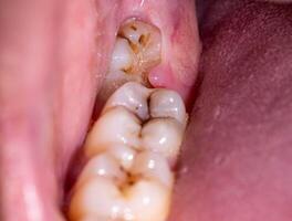 Impacted wisdom tooth due to which a gum hood was formed. Inflammation of the gums due to an unerupted molar, macro photo