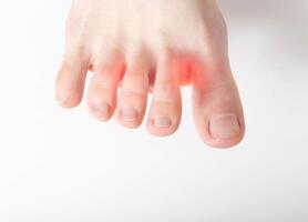 Dry skin and irritation between the toes, white background. Fungus and mycosis treatment concept, Copy space for text photo