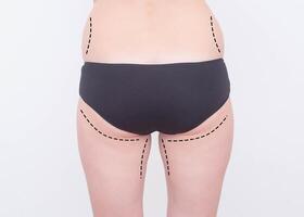 Marks on the legs and buttocks of a girl on a white background. The concept of buttock augmentation and shaping in cosmetology with implants, implant plastic, liposuction photo