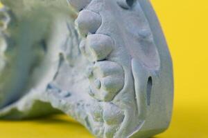 Blue plaster impression of a patient's dental jaw with crooked teeth and malocclusions on a yellow background. Manufacturing of bridges, crowns of various types, macro, arrangement of teeth photo
