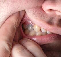 Black tooth in the mouth of a man after nerve depulpation. Dead darkened tooth, macro photo