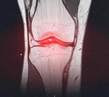 A snapshot of the diagnosis of an MRI of the knee in which arthrosis and arthritis. The concept of joint diagnosis using x-rays, treatment of diseases of the knee joint, bursitis photo