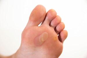 Human foot with a large callus and chicken jowl wart on a white background, close-up. Human papilloma virus photo
