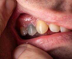A black tooth in a man's mouth after removal of a nerve and filling of dental canals with low-quality materials. Tooth whitening, close-up photo