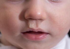 Close-up of a small child's face and nose with snot. The concept of colds, rhinitis and runny nose in children. photo