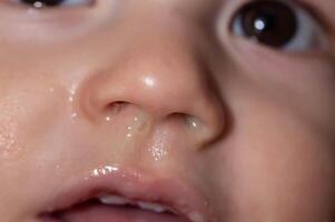 Yellow snot from a child s nose, close-up. Sinus infections, colds and virus. Chronic runny nose, adenoviruses photo