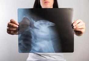 The girl holds an x-ray with outstretched arms showing a dislocation of the humerus and a fracture of the head of the bone. Traumatology and orthopedics. Surgery after dislocation, treatment photo