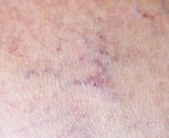 Vascular asterisk on the patient s skin. The concept of varicose veins in humans, background, macro, phlebeurysm photo