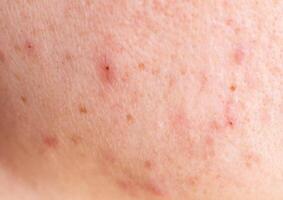 Red acne on the girl's face, background, macro photo