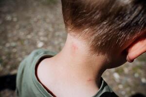Insects bit the boy in the neck, bite marks from a midge, red dots on the child's body, irritation and itching of the skin, allergy to the bite. photo