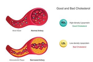 Good cholesterol, HDL, aids heart health, while bad cholesterol, LDL, increases heart risk vector
