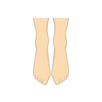 Hallux valgus, bunion. Problem with foot vector
