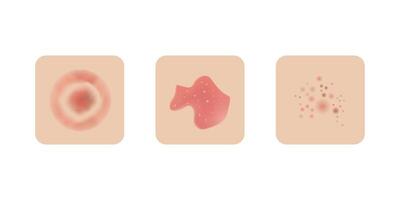 Skin allergy examples design, dermatology problems. Red rash and spots, itchy, swollen redness. vector