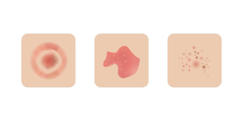 Skin allergy examples design, dermatology problems. Red rash and spots, itchy, swollen redness.