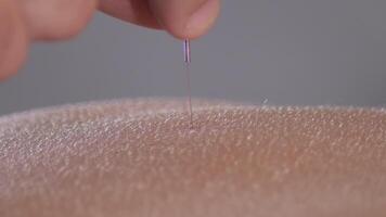 Acupuncturist removing acupuncture needle in a acupuncture session video