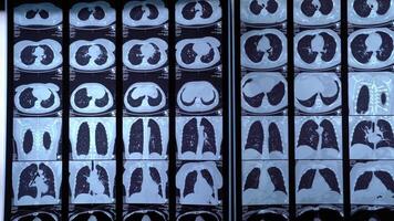 en stor siffra av x - strålar som visar annorlunda typer av lungor video