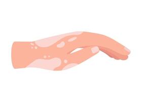 Vitiligo on skin of hand. Body with area pigmentation different color. Autoimmune disease illustration vector