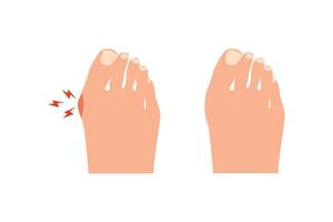 Bunion before and after operation. vector