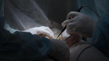 Cardiac surgeon and team perform median sternotomy. Action. Surgeon cauterizing and using professional tool. video