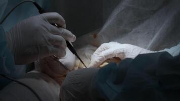 Cardiac surgeon and team perform median sternotomy. Action. Surgeon cauterizing and using professional tool. video