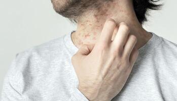 Eczema and itching concept. Red spots on skin of man, empty space, cropped photo