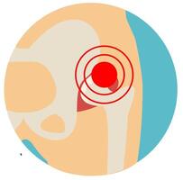 Hip Osteoarthritis icon. Flat style. Front view of hip joint with section of the pelvis. Lower back and joint pain. Medical, healthcare vector