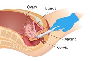 Examination of the uterus and ovaries using transvaginal ultrasound vector