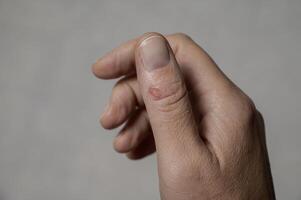there is a fresh wound on the thumb photo