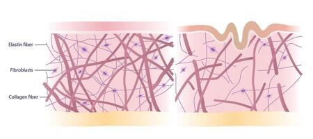 Cross section of skin layer with intact and damaged collagen, elastin fibers and fibroblasts in the dermis illustration on white background. Comparison of young healthy and aging wrinkled skin. vector