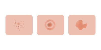 Atopic dermatitis examples, medical problems. Red rash and spots, itchy, swollen redness skin. vector