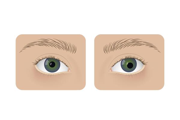 Realistic human normal eyes and with corectopia. Human sick, anatomy, health.