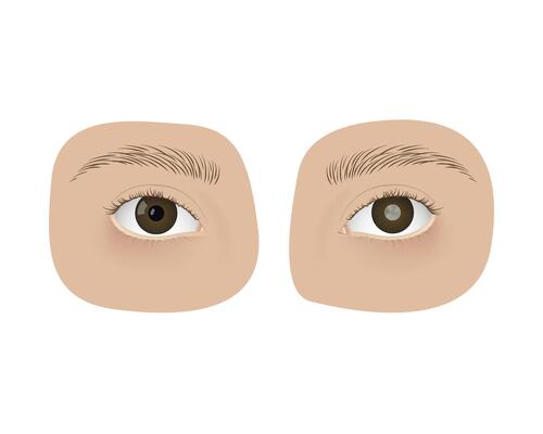 Realistic human healthy eye and with cataract. Disease, anatomy, health.