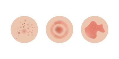 Neurodermatitis examples, allergic problems. Red rash and spots, itchy, swollen redness skin. vector