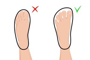Feet in barefoot and regular shoes infographic. Compare comfortable and orthopedic footwear with regular. vector