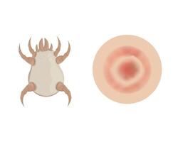 Skin allergy to dust mites. White microscopic bug causes atopic dermatitis. vector