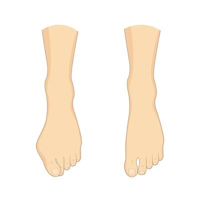 Hallux valgus, mild bunion correction. Medical surgery orthopedics