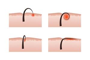 Ingrown hairs after epilation. Skin structure. vector