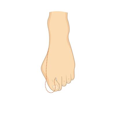 Hallux valgus surgery correction. Medical orthopedics